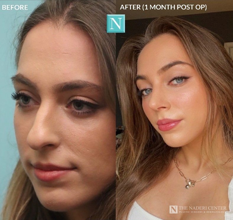Rhinoplasty before and after, real patient at The Naderi Center in Reston, VA and Chevy Chase, MD
