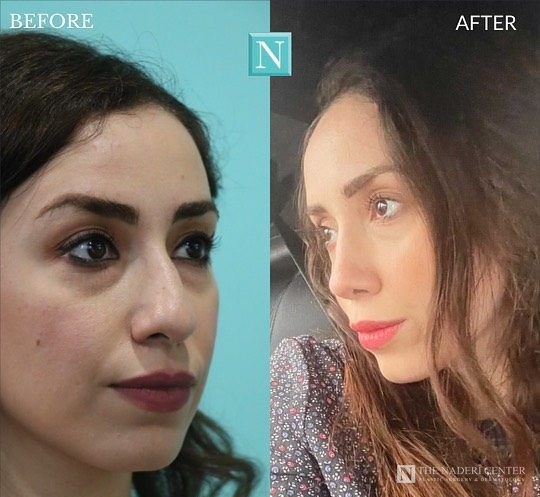 Rhinoplasty before and after, real patient at The Naderi Center in Reston, VA and Chevy Chase, MD