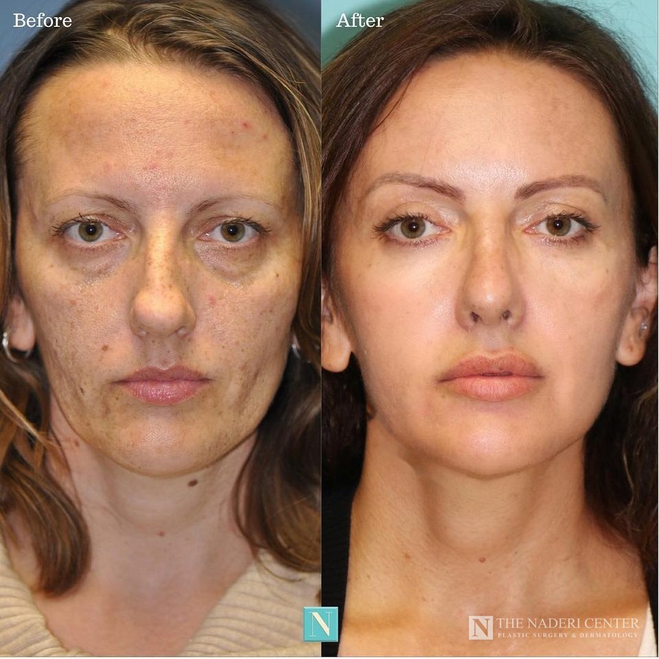 Rhinoplasty, eyelid surgery, fat transfer and CO2 laser before and after, real patient at The Naderi Center in Reston, VA and Chevy Chase, MD