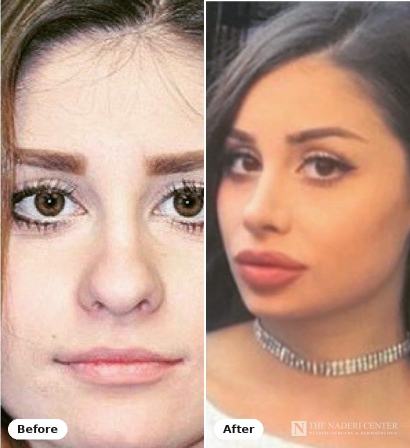 Rhinoplasty and lip filler before and after, real patient at The Naderi Center in Reston, VA and Chevy Chase, MD