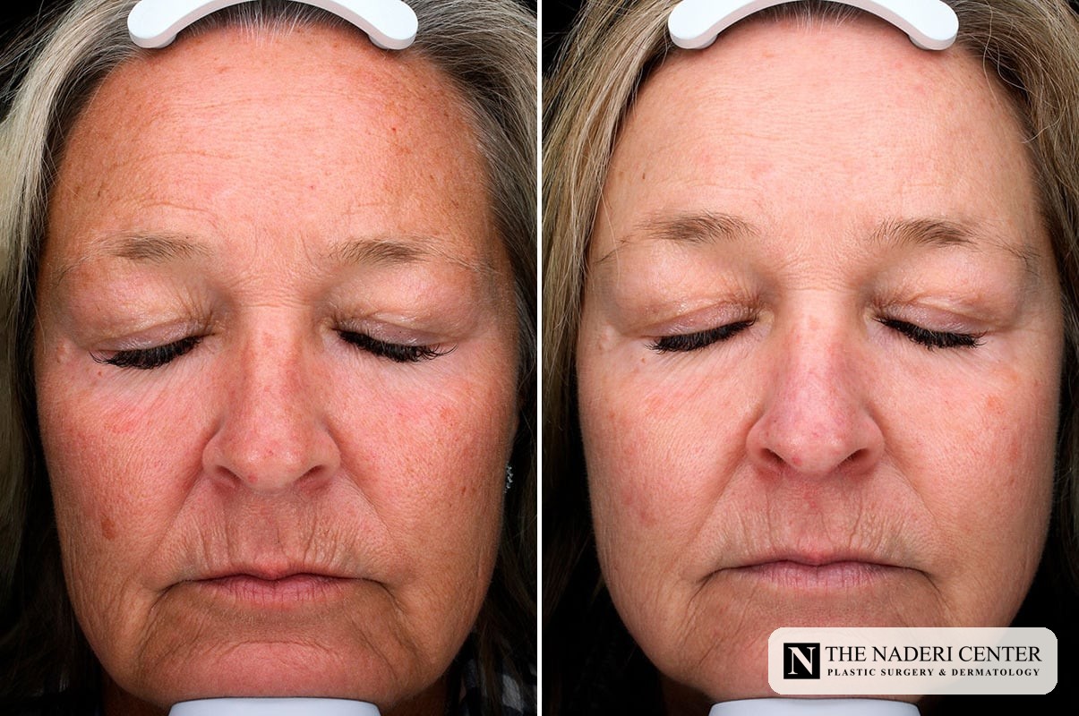 Before and after one Sciton BBL treatment for red and brown pigmentation at The Naderi Center