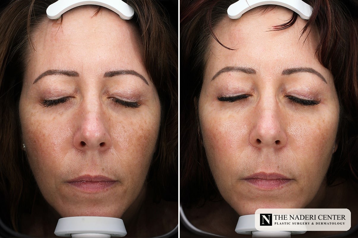 Before and after a series of Sciton BBL treatments for brown and red pigmentation at The Naderi Center
