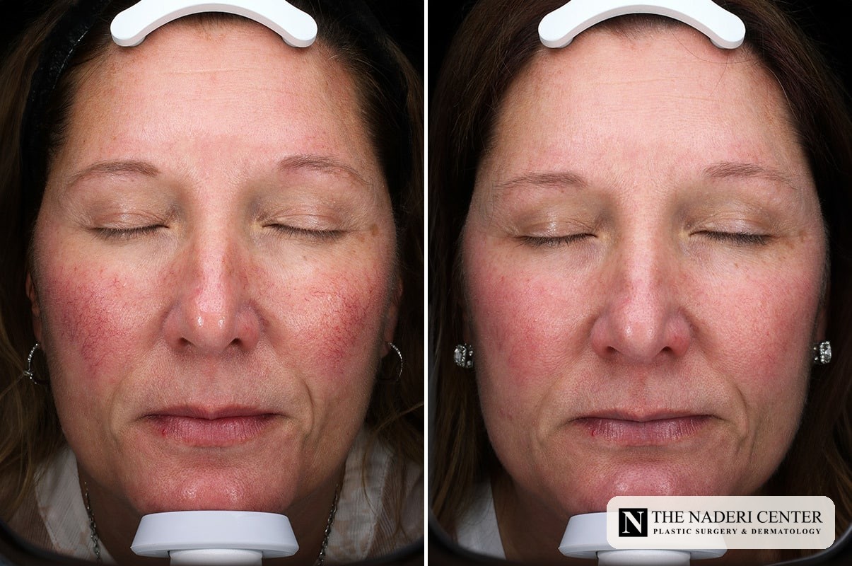Before and after three Sciton BBL sessions for facial redness at The Naderi Center