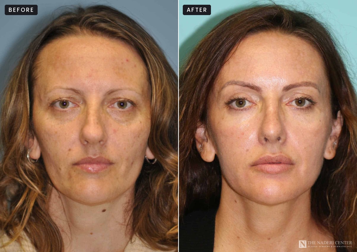 Before and after full-face CO2 laser resurfacing for sun damage, The Naderi Center