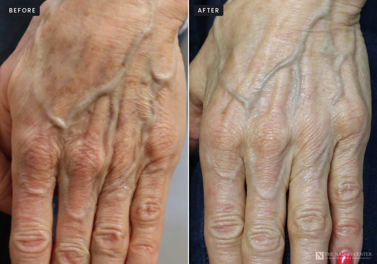 Hand before and after Sciton BBL treatments for sun spots, The Naderi Center