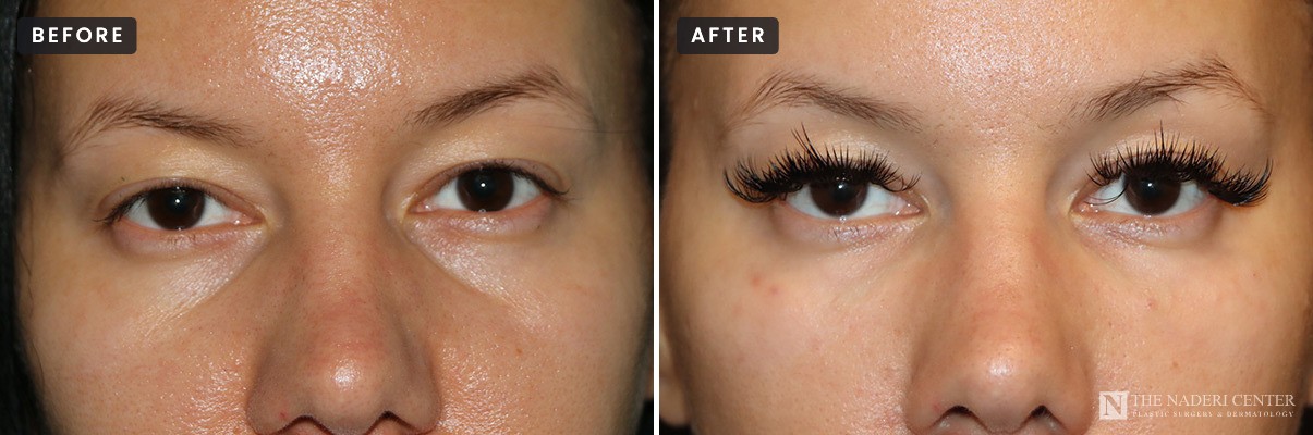 Tear trough filler before and after: close-up of the under-eyes before (left) and right after one syringe of Restylane-L in both tear troughs (right), The Naderi Center