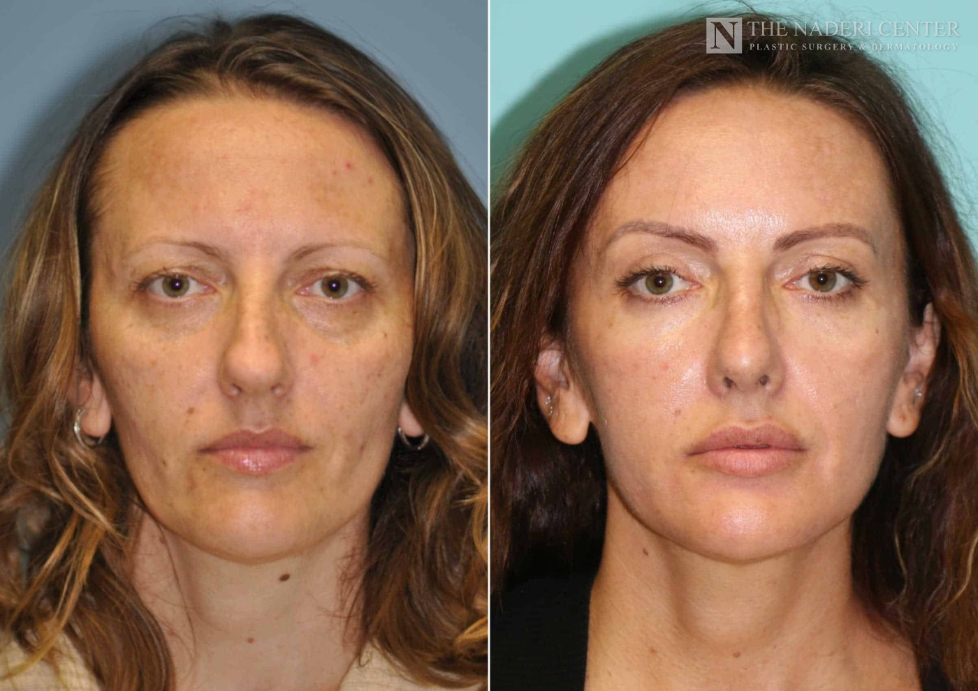 Before and after temporal brow lift at The Naderi Center, Reston, VA and Chevy Chase, MD, front view