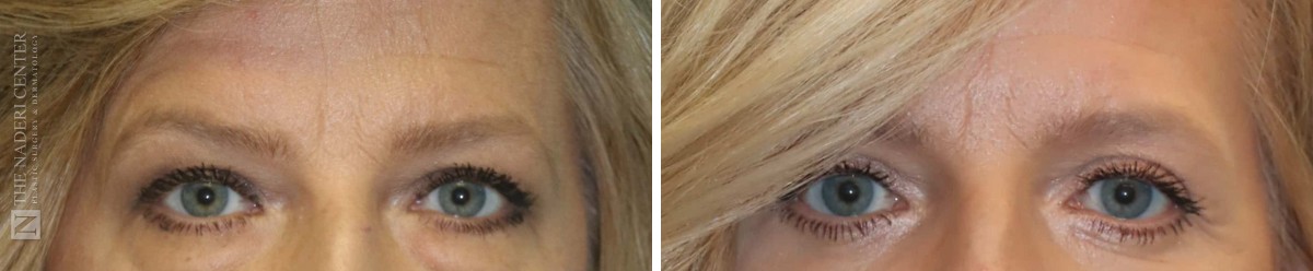 Before and after temporal brow lift with eyelid surgery and CO2 laser at The Naderi Center, close-up of the brows and eyes