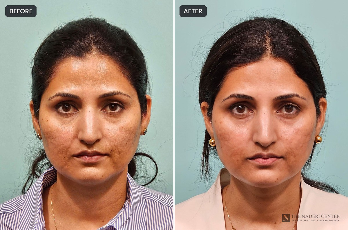 Before and after one UltraClear laser treatment for acne scarring and skin texture, front view, patient of The Naderi Center