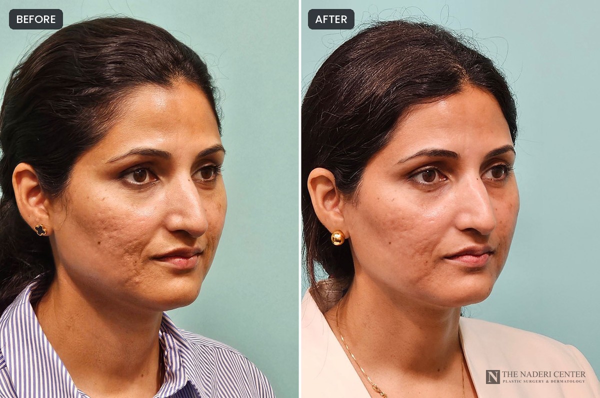 Before and after one UltraClear laser treatment for acne scarring and skin texture, side view, patient of The Naderi Center