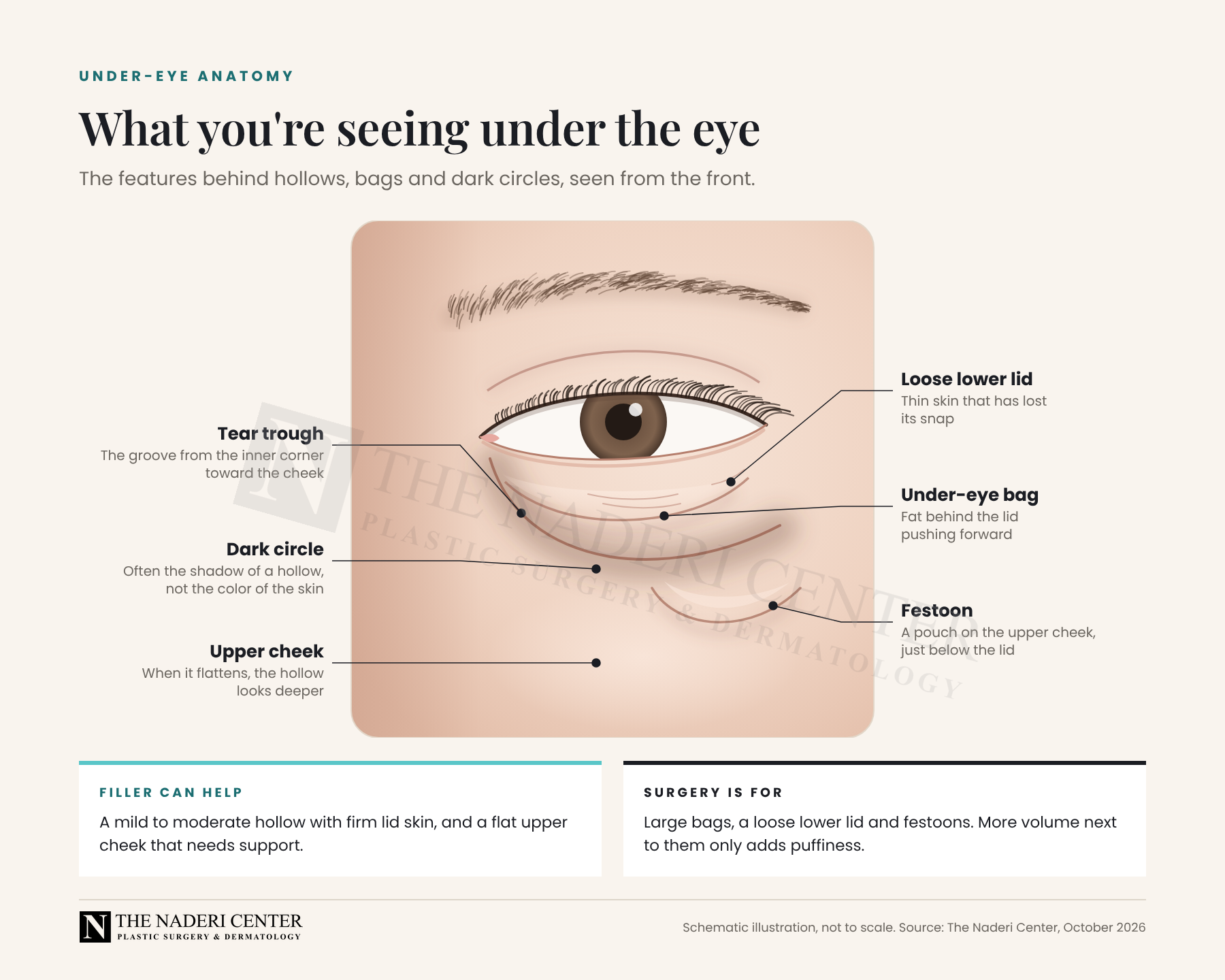 Labeled illustration of the under-eye area showing the tear trough, the dark circle shadow, the upper cheek, a loose lower lid, an under-eye bag and a festoon