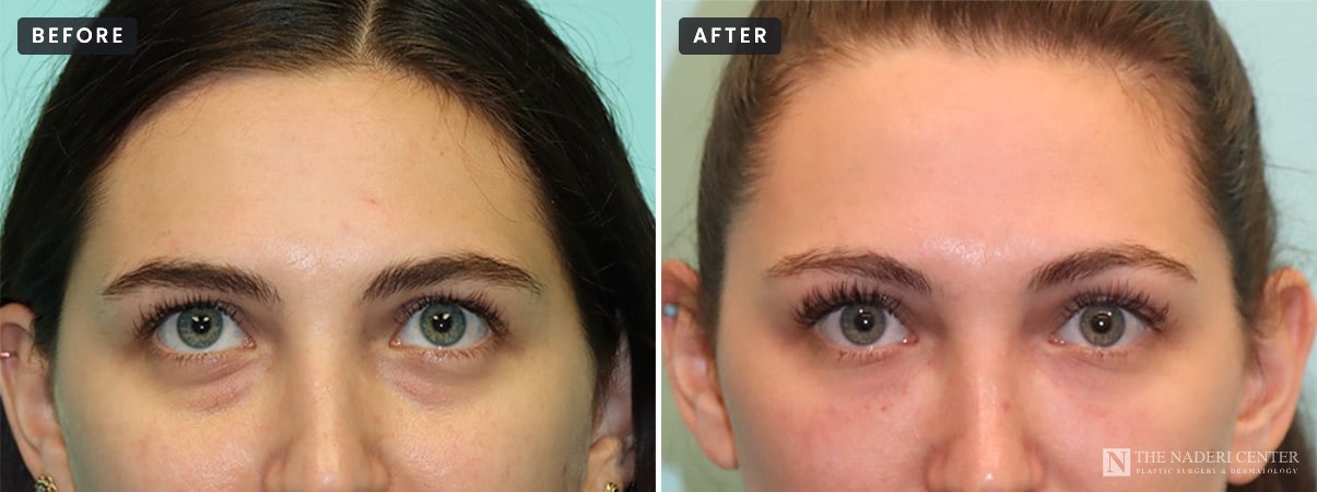 Under-eye filler before and after: front view of a patient before (left) and after one syringe of Restylane in the tear troughs (right), The Naderi Center