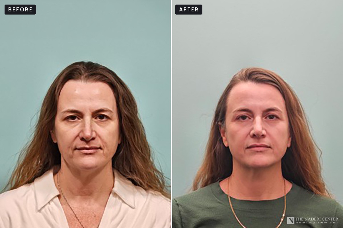 Before and after UltraClear laser treatment for uneven skin tone, The Naderi Center