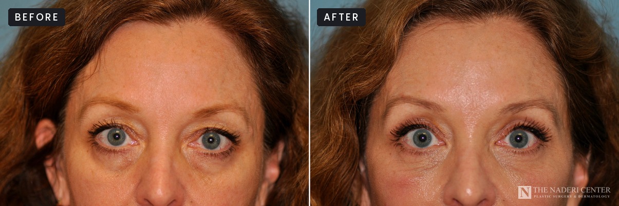 Before and after upper blepharoplasty for sagging upper eyelid skin, eyes open, at The Naderi Center