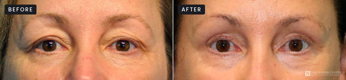 Before and after upper blepharoplasty with CO2 laser resurfacing for heavy, hooded upper eyelids at The Naderi Center