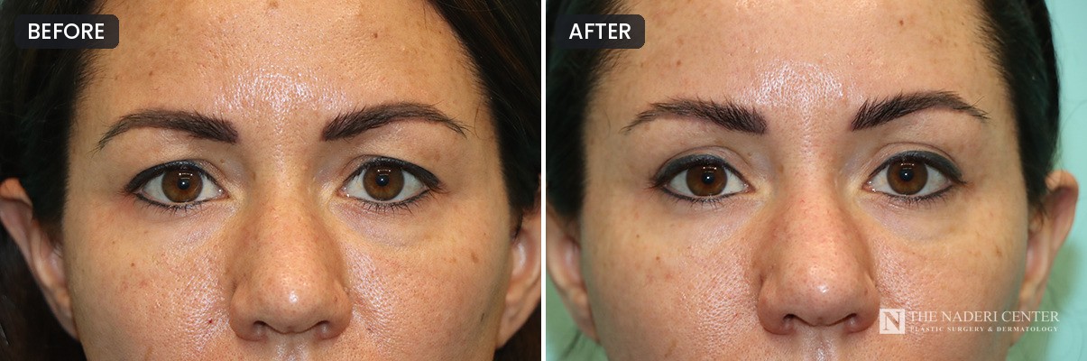 Before and after upper blepharoplasty to remove excess upper eyelid skin at The Naderi Center