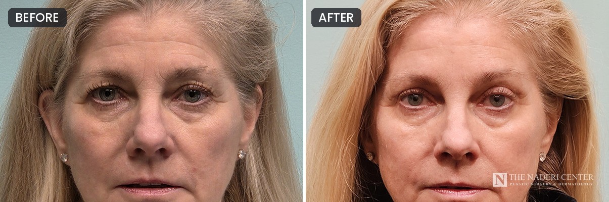 Before and after endoscopic brow lift and upper blepharoplasty, eyes open, at The Naderi Center