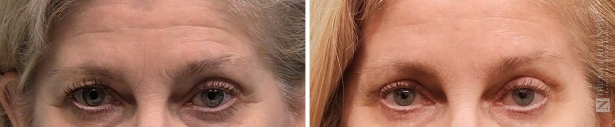 Upper eyelid surgery and brow lift before and after, close-up of the eyes and forehead, The Naderi Center, Reston, VA and Chevy Chase, MD