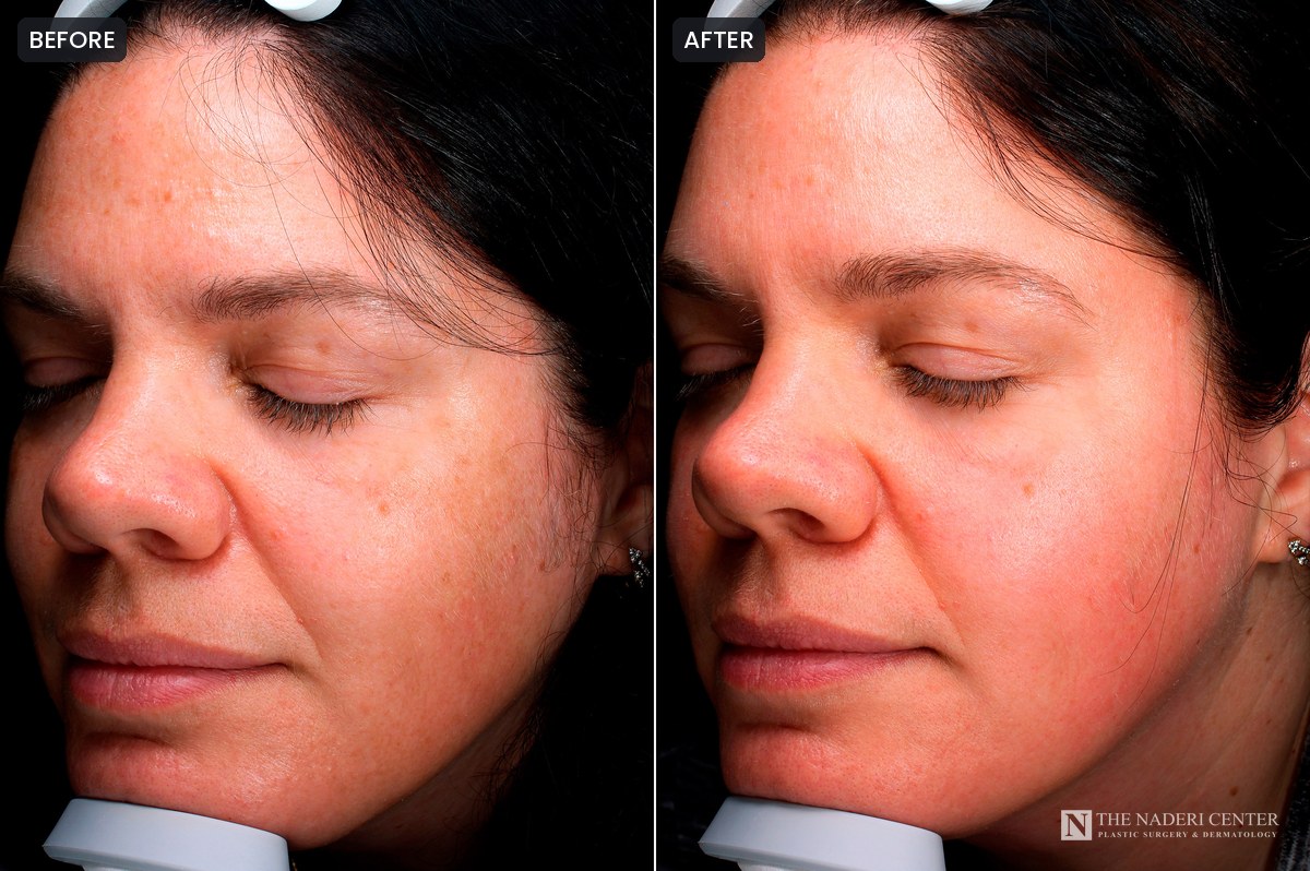 Before and after three VI Precision Purify peels, showing more even pigmentation and smoother texture, at The Naderi Center