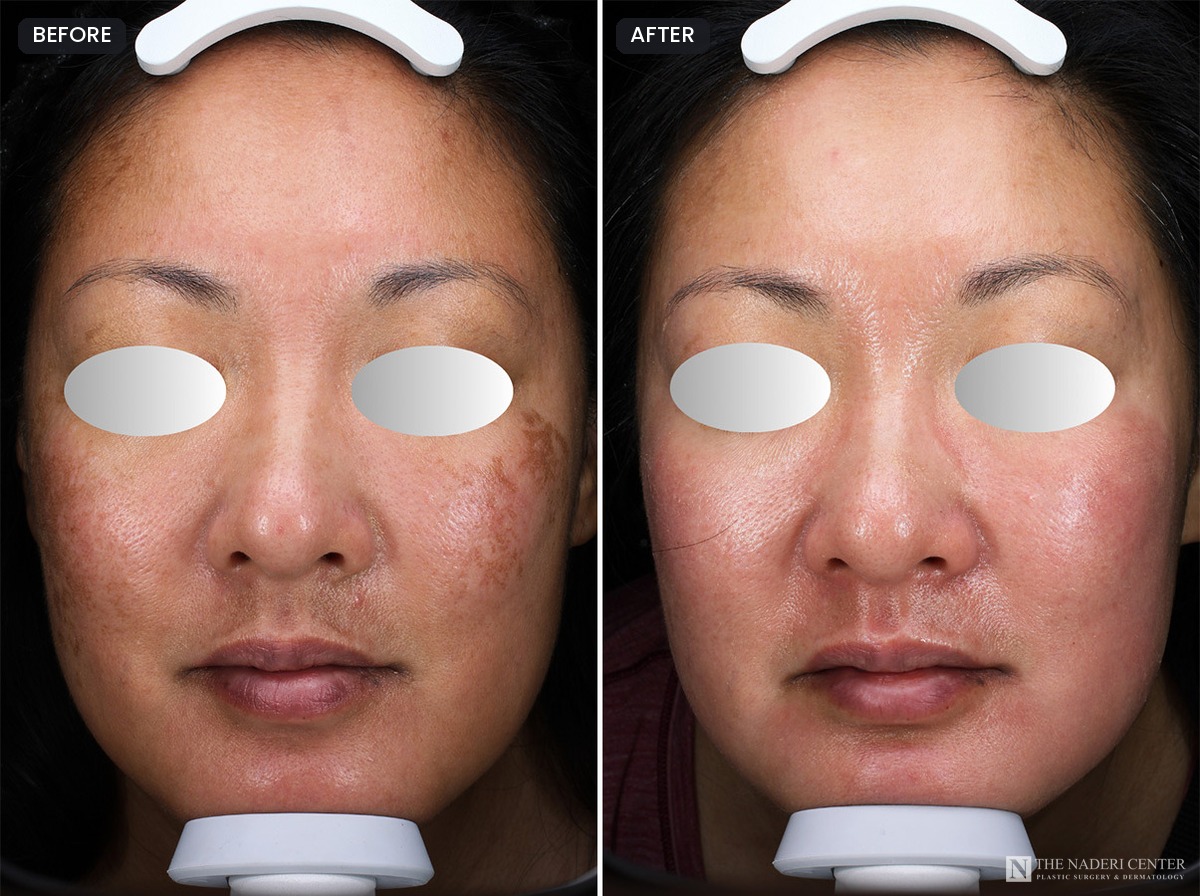 VI Peel before and after: front view showing reduced brown pigment on the cheeks after VI Peel treatments at The Naderi Center