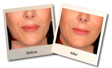 Before and After wrinkles can be fixed with filler at The Naderi Center in Virginia and Maryland