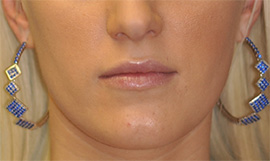Virginia Lip Augmentation Front Before in Herndon & Chevy Chase Virginia Lip Augmentation Front Before in Herndon & Chevy Chase