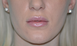 Virginia Lip Augmentation Front After in Herndon & Chevy Chase Virginia Lip Augmentation Front After in Herndon & Chevy Chase