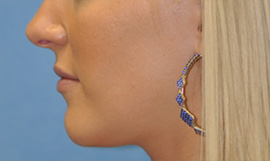 Virginia Lip Augmentation Lateral Before in Herndon & Chevy Chase Virginia Lip Augmentation Lateral Before in Herndon & Chevy Chase