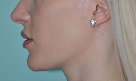 Virginia Lip Augmentation Lateral After in Herndon & Chevy Chase Virginia Lip Augmentation Lateral After in Herndon & Chevy Chase
