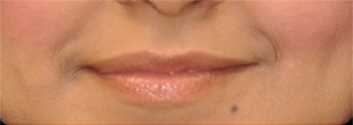 Permalip Lip Implants, prior to surgery in Reston, VA