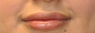 1 week after lip implant Chevy Chase, MD