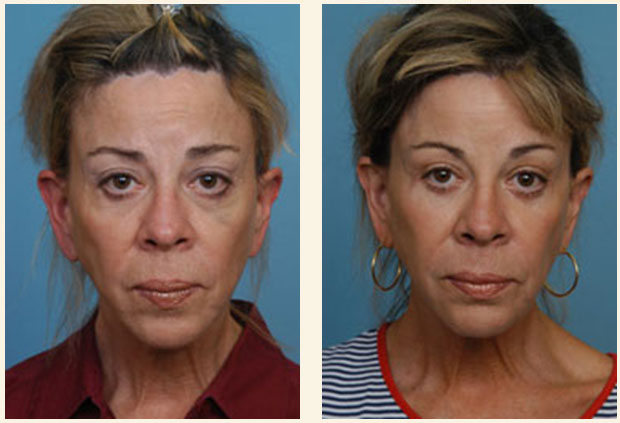 Liquid Mid Facelift | Virginia Liquid Mid Facelift | Virginia