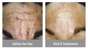 Before and After the Peel - 2