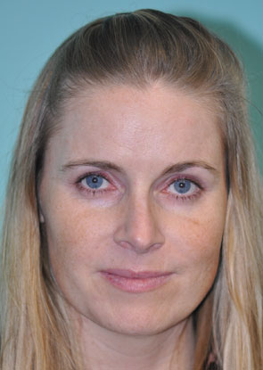 Virginia Fraxel Before - 2 Virginia Fraxel Before - 2