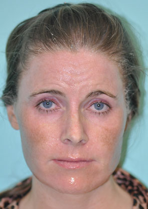 Virginia Fraxel Before - 2 Virginia Fraxel Before - 2
