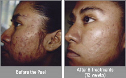 Before and After the Peel